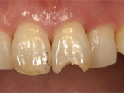 奥歯のインプラント治療前