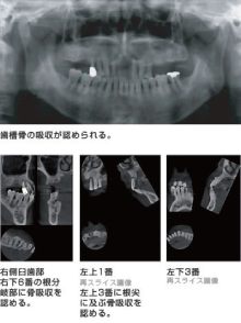 矯正治療のＣＴ画像